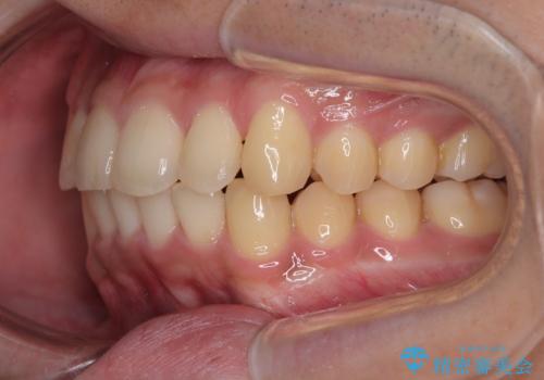 前歯のデコボコを治したい ワイヤー装置での非抜歯矯正の治療後