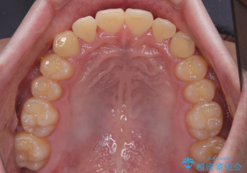 前歯のデコボコを治したい ワイヤー装置での非抜歯矯正の治療後