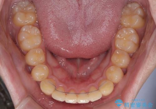 前歯のデコボコを治したい ワイヤー装置での非抜歯矯正の治療後