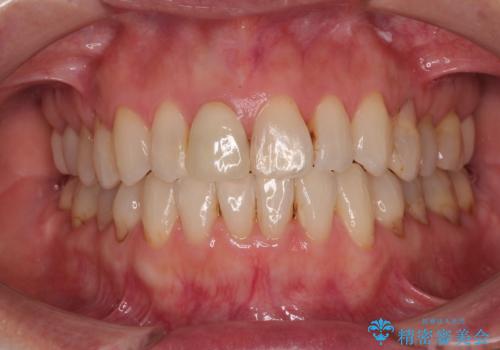 デコボコと銀歯 矯正治療とセラミック治療で綺麗な口元にの症例 治療後