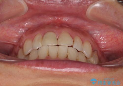 デコボコと銀歯 矯正治療とセラミック治療で綺麗な口元にの治療後