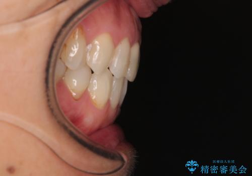 デコボコと銀歯 矯正治療とセラミック治療で綺麗な口元にの治療後