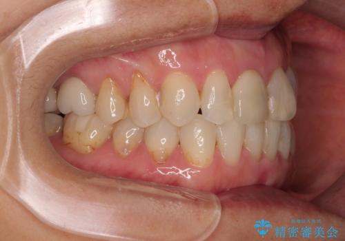 デコボコと銀歯 矯正治療とセラミック治療で綺麗な口元にの治療後