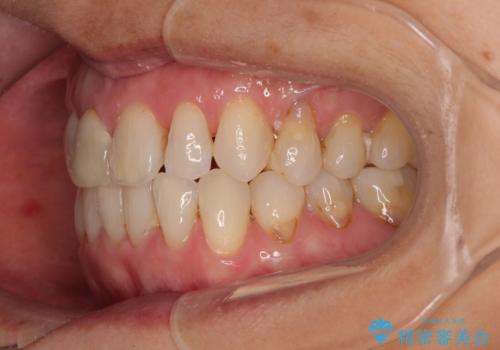 デコボコと銀歯 矯正治療とセラミック治療で綺麗な口元にの治療後