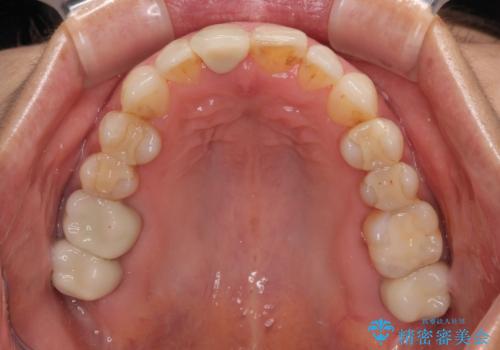 デコボコと銀歯　矯正治療とセラミック治療で綺麗な口元にの治療後