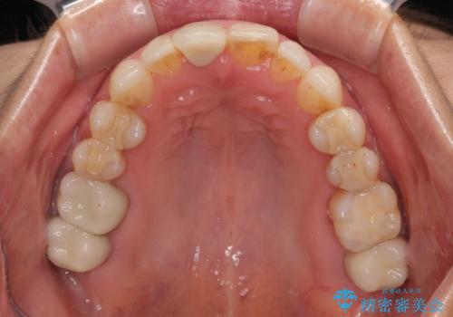 デコボコと銀歯 矯正治療とセラミック治療で綺麗な口元にの治療後