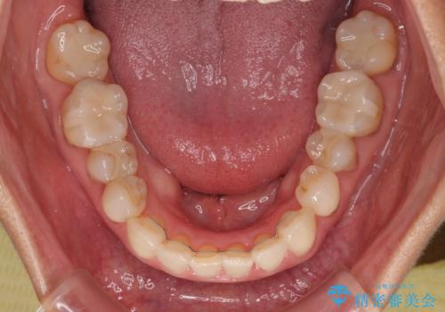 デコボコと銀歯 矯正治療とセラミック治療で綺麗な口元にの治療後