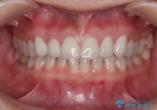 転んで欠けた前歯を治したい。オールセラミッククラウンによる補綴の症例 治療後