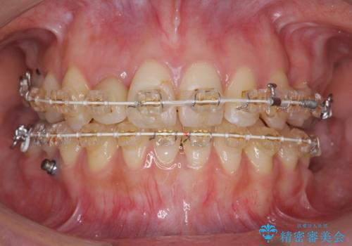 あきらめないで!!虫歯でボロボロでも大丈夫!　非抜歯矯正と虫歯、インプラント治療で見違える歯並びに。の治療中