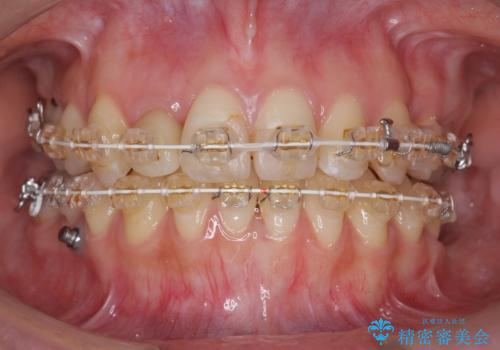 あきらめないで!!虫歯でボロボロでも大丈夫! 非抜歯矯正と虫歯、インプラント治療で見違える歯並びに。の治療中
