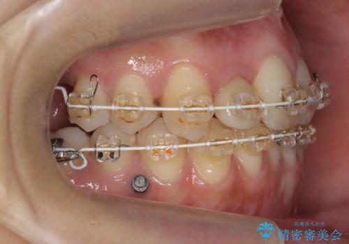 あきらめないで!!虫歯でボロボロでも大丈夫!　非抜歯矯正と虫歯、インプラント治療で見違える歯並びに。の治療中