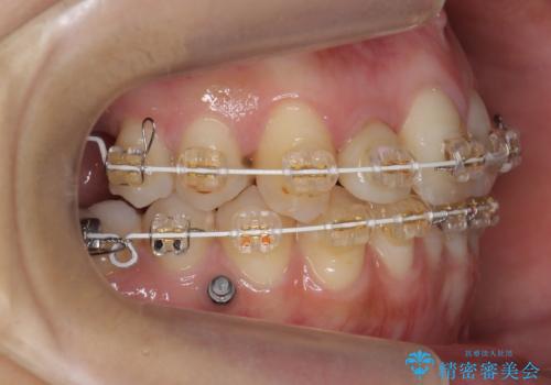 あきらめないで!!虫歯でボロボロでも大丈夫! 非抜歯矯正と虫歯、インプラント治療で見違える歯並びに。の治療中