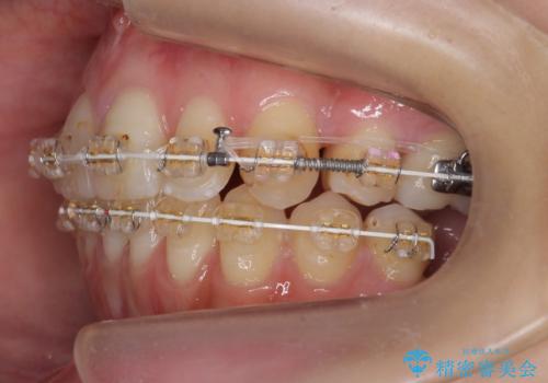 あきらめないで!!虫歯でボロボロでも大丈夫! 非抜歯矯正と虫歯、インプラント治療で見違える歯並びに。の治療中