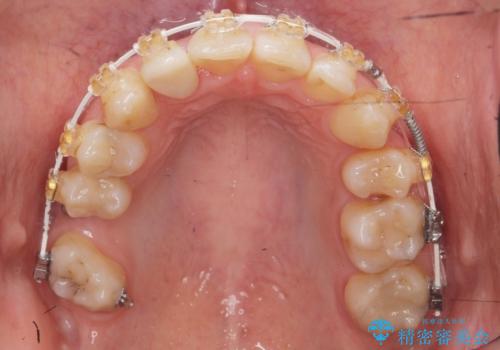 あきらめないで!!虫歯でボロボロでも大丈夫! 非抜歯矯正と虫歯、インプラント治療で見違える歯並びに。の治療中