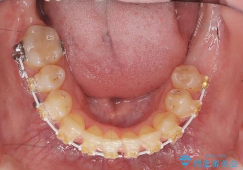 あきらめないで!!虫歯でボロボロでも大丈夫! 非抜歯矯正と虫歯、インプラント治療で見違える歯並びに。の治療中