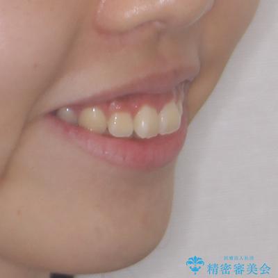 飛び出ている出っ歯を治したい 目立たない装置での抜歯矯正治療の治療前(顔貌)
