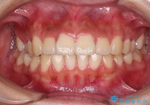 飛び出ている出っ歯を治したい 目立たない装置での抜歯矯正治療の症例 治療前