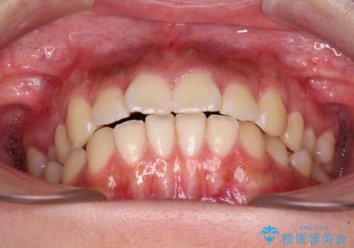 飛び出ている出っ歯を治したい 目立たない装置での抜歯矯正治療の治療前
