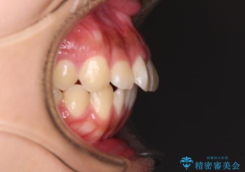 飛び出ている出っ歯を治したい 目立たない装置での抜歯矯正治療の治療前