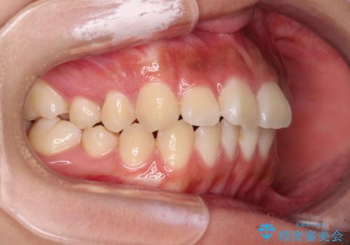 飛び出ている出っ歯を治したい 目立たない装置での抜歯矯正治療の治療前