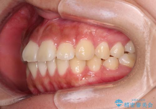 飛び出ている出っ歯を治したい 目立たない装置での抜歯矯正治療の治療前