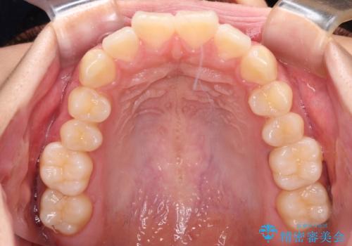 飛べ出ている出っ歯を治したい　目立たない装置での抜歯矯正治療の治療前