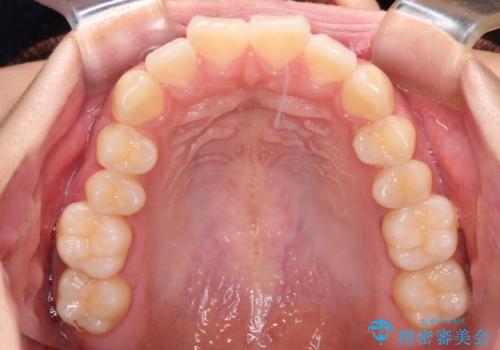 飛び出ている出っ歯を治したい 目立たない装置での抜歯矯正治療の治療前