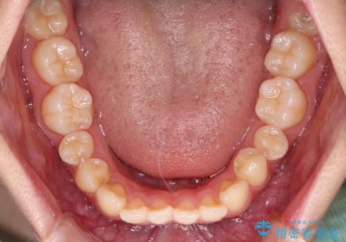 飛び出ている出っ歯を治したい 目立たない装置での抜歯矯正治療の治療前