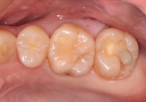 虫歯の再発　セラミックインレーにて治療の治療中