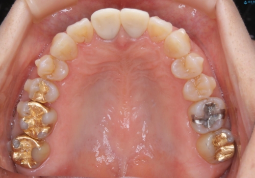 【非抜歯】加速矯正で超短期間治療!噛み合わせが劇的に改善の治療中