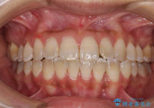 全く目立たないワイヤー矯正 上下裏側矯正の症例 治療後