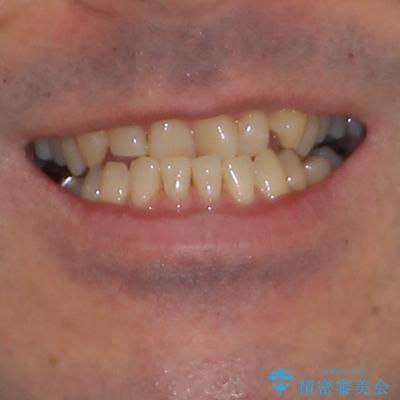 受け口を治す ワイヤー装置での矯正治療の治療前(顔貌)