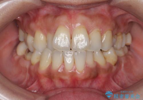 コーヒーの着色を綺麗にの症例 治療後