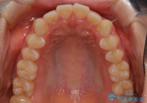 下顎前歯の叢生を短期間で改善の治療前