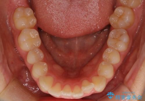 下顎前歯の叢生を短期間で改善の治療前