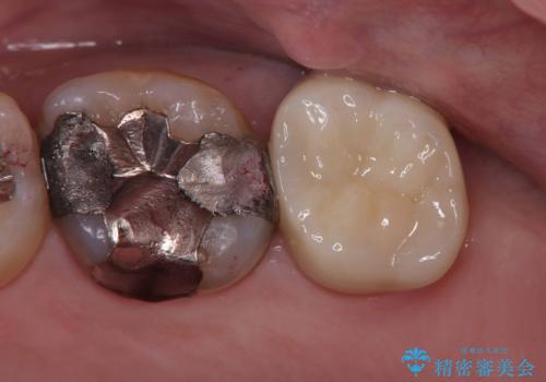 【フルジルコニアクラウン】銀歯二次カリエス!