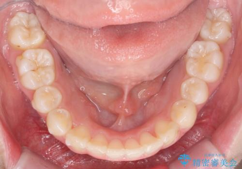 サクソフォン(アルト)の演奏で崩れてしまった歯並び、マウスピース矯正治療の治療中