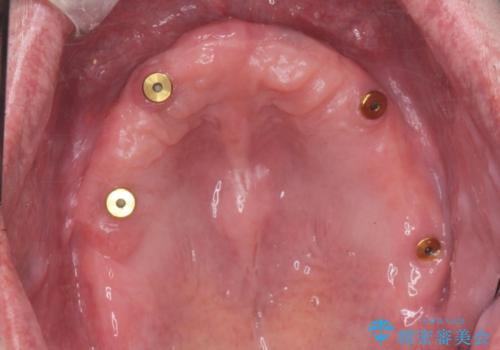 全体的に治したい。インプラントオーバーデンチャーによる治療。の治療中