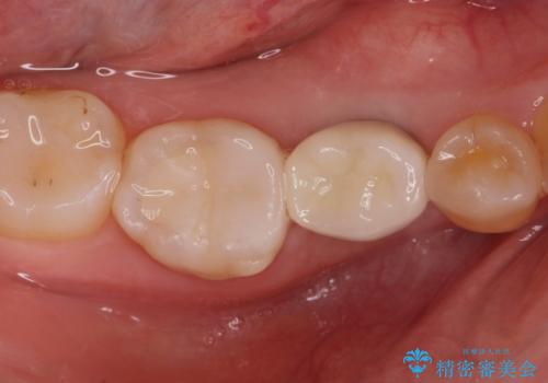 インプラント治療の症例 治療後