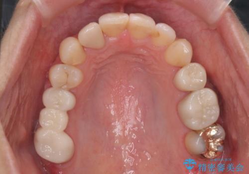 あきらめないで!!虫歯でボロボロでも大丈夫! 非抜歯矯正と虫歯、インプラント治療で見違える歯並びに。の治療後