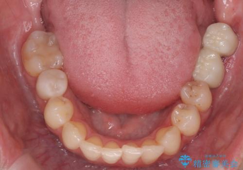 あきらめないで!!虫歯でボロボロでも大丈夫! 非抜歯矯正と虫歯、インプラント治療で見違える歯並びに。の治療後