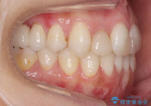 あきらめないで!!虫歯でボロボロでも大丈夫! 非抜歯矯正と虫歯、インプラント治療で見違える歯並びに。の治療後