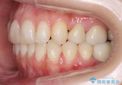 あきらめないで!!虫歯でボロボロでも大丈夫! 非抜歯矯正と虫歯、インプラント治療で見違える歯並びに。の治療後