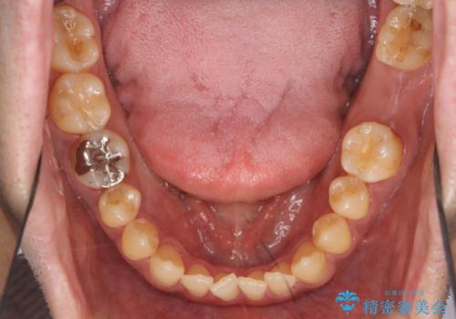 奥歯のインプラントの症例 治療前