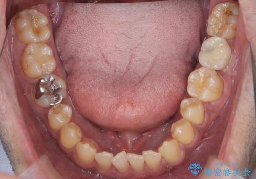 奥歯のインプラントの症例 治療後