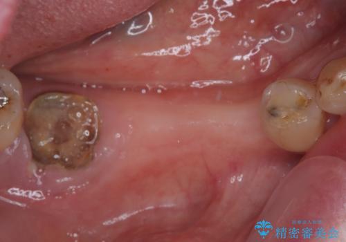 入れ歯が全く使えない 奥歯のインプラント治療の症例 治療前