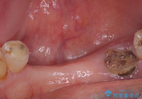 入れ歯が全く使えない　奥歯のインプラント治療の治療前