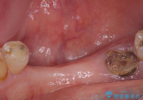 入れ歯が全く使えない 奥歯のインプラント治療の治療前