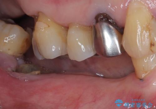 入れ歯が全く使えない 奥歯のインプラント治療の治療前