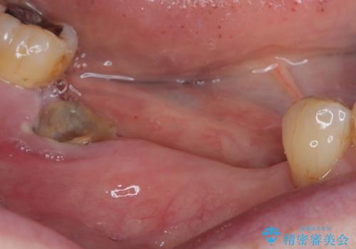 入れ歯が全く使えない　奥歯のインプラント治療の治療前
